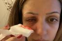 Shereen-Fay Griffin lost sight in her left eye due to a flesh eating parasite